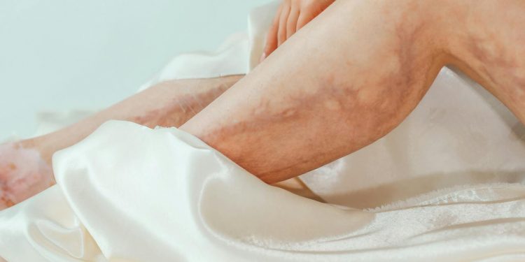 Empowering Your Vascular Health: Early Detection and Professional Management of Varicose Veins