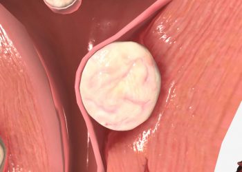 Minimally Invasive Treatments for Uterine Fibroids