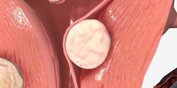 Minimally Invasive Treatments for Uterine Fibroids