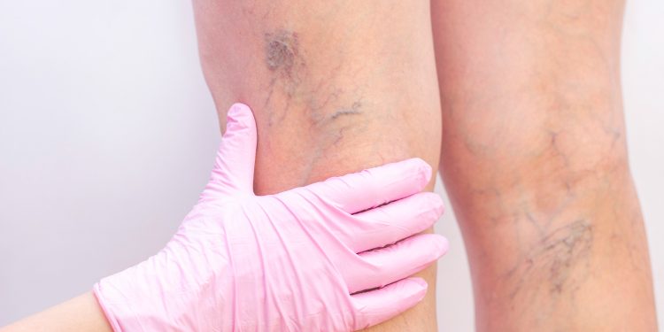 Reviving Vein Health: Effective Treatments for Vein Diseases