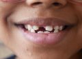 Coping with Missing Teeth