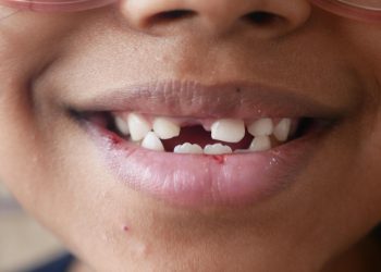 Coping with Missing Teeth