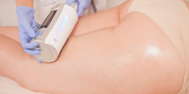 Sculpting the Back with Fat Freezing: A Permanent Solution for Men