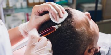 Hair Transplant London: Restore Your Confidence with Capital Hair Restoration