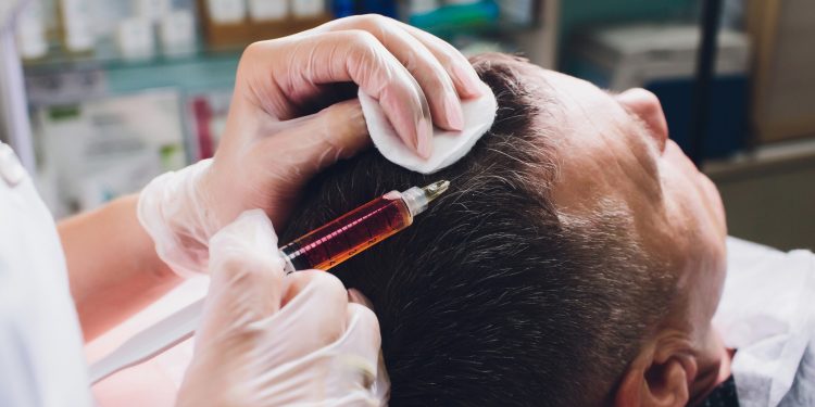Hair Transplant London: Restore Your Confidence with Capital Hair Restoration