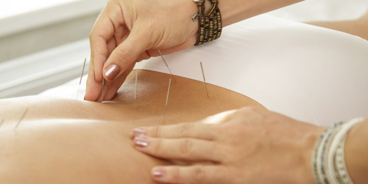 Acupuncture for Weight Loss: How It Supports Your Fitness GoalsUnderstanding Acupuncture for Weight Loss